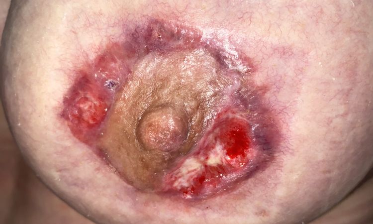 Pezón desprendido tras mastopexia con implantes - 57058