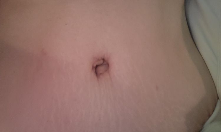 Ombligo deformado tras 4 semanas de abdominoplastia - 57371