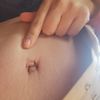 Ombligo deformado tras 4 semanas de abdominoplastia
