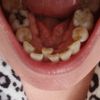 Alternativas para alinear dentadura - 57532
