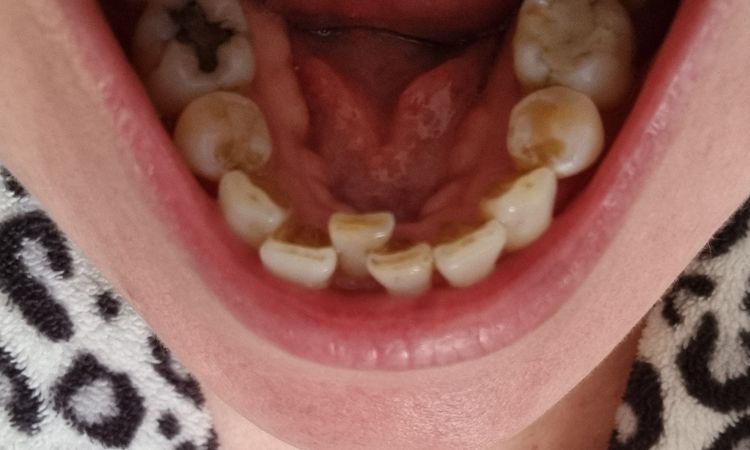 Alternativas para alinear dentadura - 57532