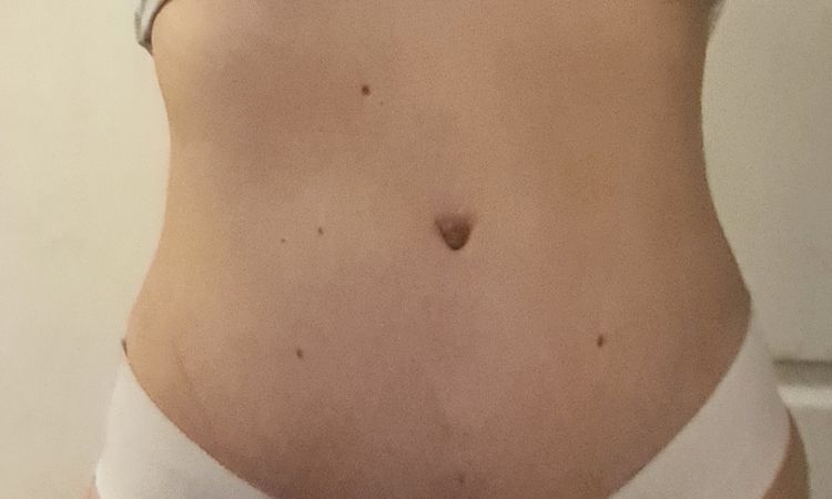 Ombligo alto tras abdominoplastia - 58809