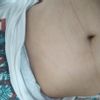 Abdominoplastia y cirugía hernia abdominal