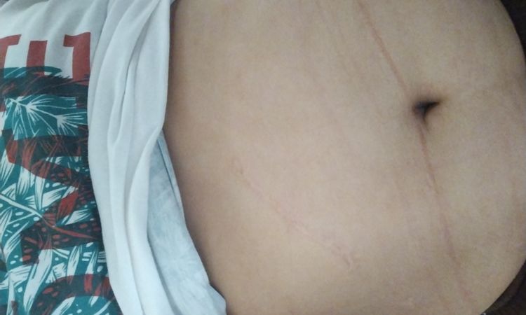 Abdominoplastia y cirugía hernia abdominal - 59013