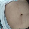 Abdominoplastia y cirugía hernia abdominal