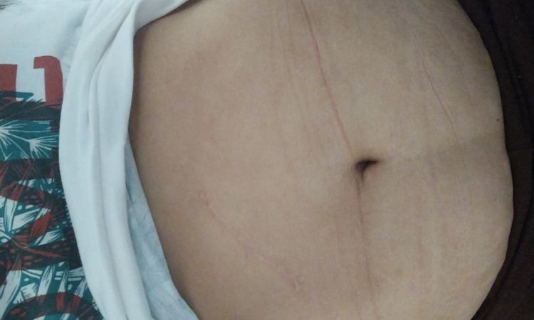 Abdominoplastia y cirugía hernia abdominal - 59014