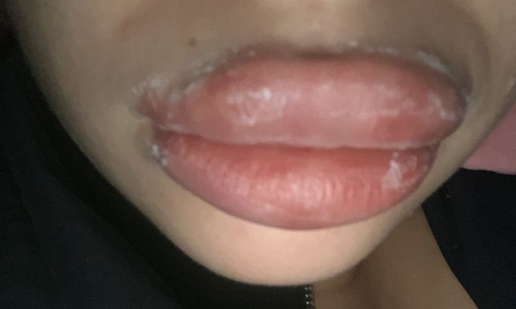 Complicación en relleno de labios con ácido hialuronico. - 60824