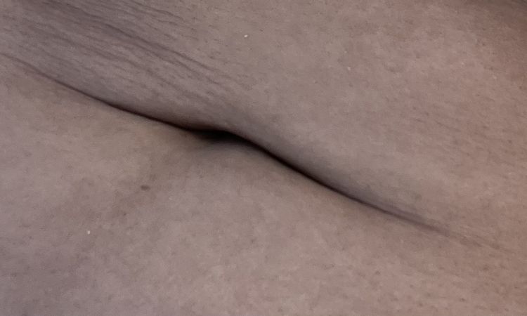 Ombligo triste post lipo - 60942