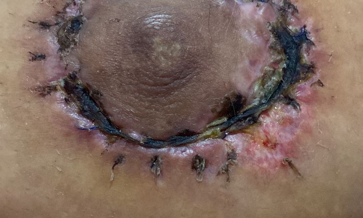 Cicatriz ancha mastopexia aerolar - 62143