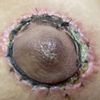 Cicatriz ancha mastopexia aerolar