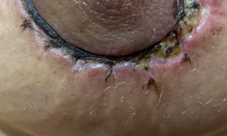 Cicatriz ancha mastopexia aerolar - 62144