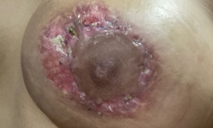Cicatriz ancha mastopexia aerolar - 62146