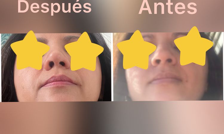 Operación ambulatoria a los 7 meses de Rinoseptoplastia - 62695