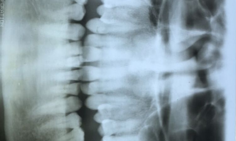 ¿Es necesario realizar un injerto de hueso antes de la cirugía ortognática? - 62697