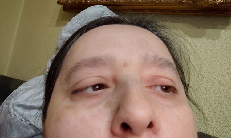 No puedo respirar después de rinoplastia - 63159