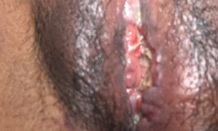 Bulto en mi labio genital dolor y ardor despúes de labioplastía - 63414