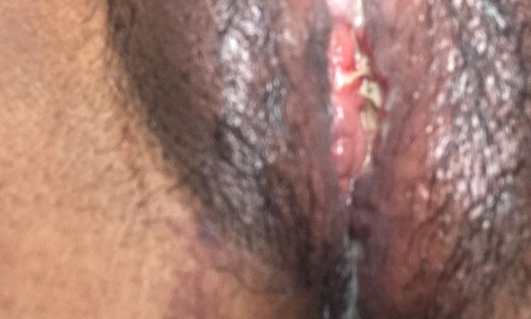 Bulto en mi labio genital dolor y ardor despúes de labioplastía - 63415