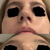 Modificación manual del hueso nasal