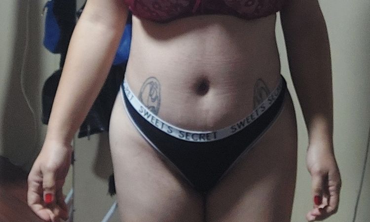 ¿Necesitaré retoque liposuccion? - 65425