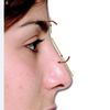 Es posible disminuir el radix nasal con cirugía?