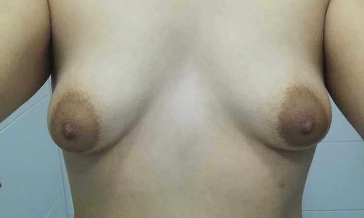 Asimetría y Molestia tras aumento mamario en mamas tuberosas - 67436