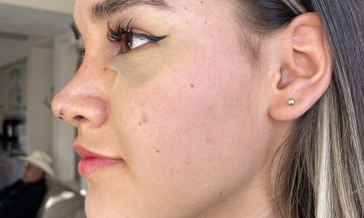 Cuanto se usan las micropore después de la rino? - 67822