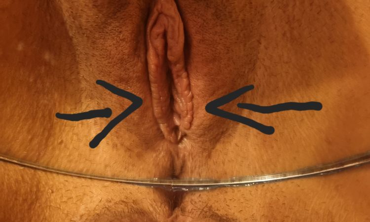 Reconstrucción de labios menores - 74192