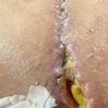Serosa Recurente post Abdominoplastia (1 mes aun)