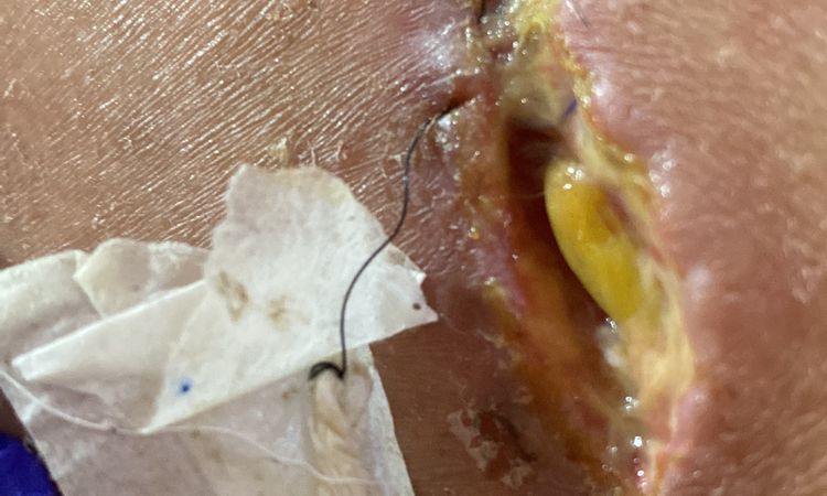 Serosa Recurente post Abdominoplastia (1 mes aun) - 74919
