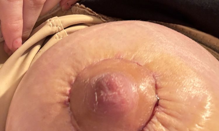 Pezones inflamados tras Mastopexia , pliegues alrededor de la cicatriz - 77029