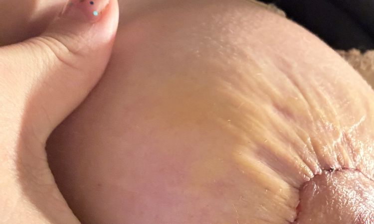 Pezones inflamados tras Mastopexia , pliegues alrededor de la cicatriz - 77030