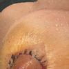 Pezones inflamados tras Mastopexia  , pliegues alrededor de la cicatriz