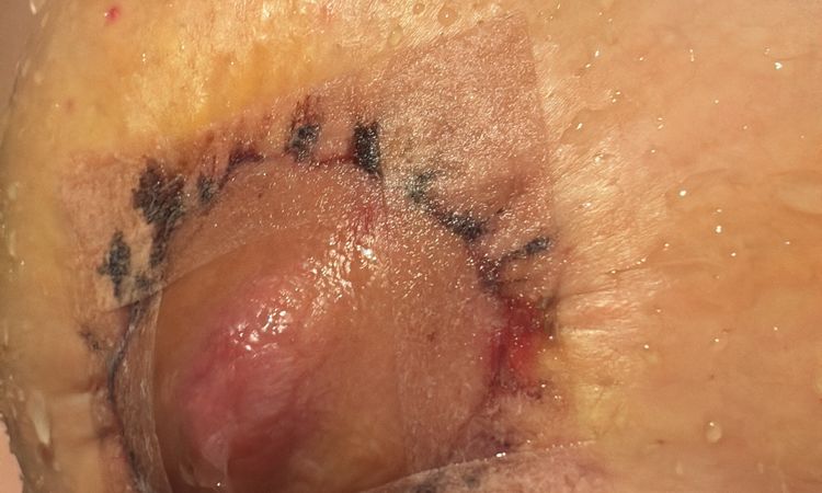 Pezones inflamados tras Mastopexia , pliegues alrededor de la cicatriz - 77031