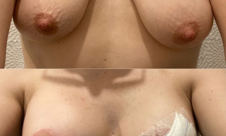 Mastopexia con diferentes tamaños de implantes  :C - 78862
