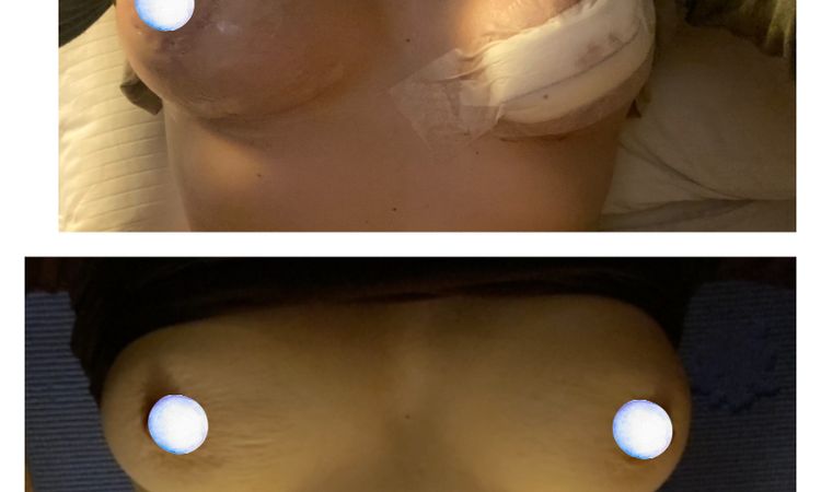 Mastopexia con diferentes tamaños de implantes  :C - 78863