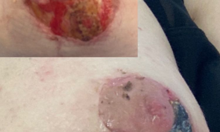 Mastopexia con diferentes tamaños de implantes  :C - 78864