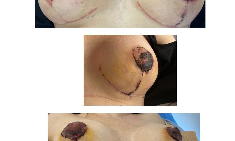 Mastopexia con diferentes tamaños de implantes  :C - 78865
