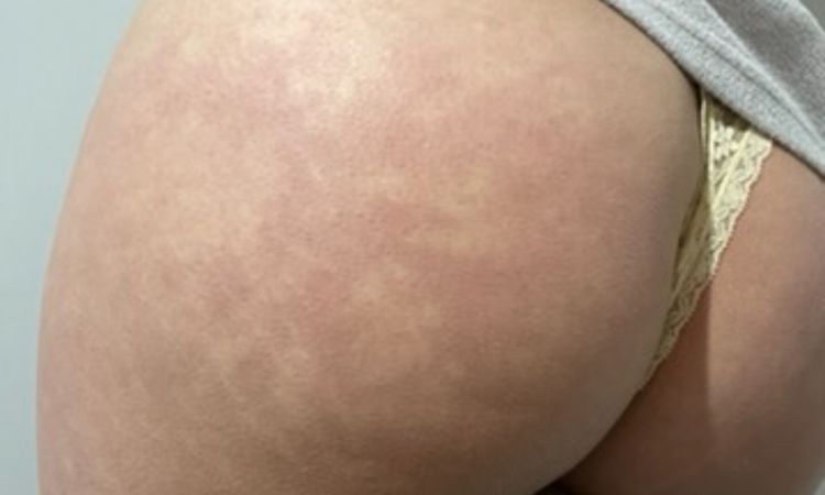 Bulto en gluteo luego de lipotransferencia de grasa. - 79351