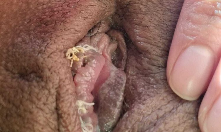 ¿Mala suturación labioplastia? - 80321
