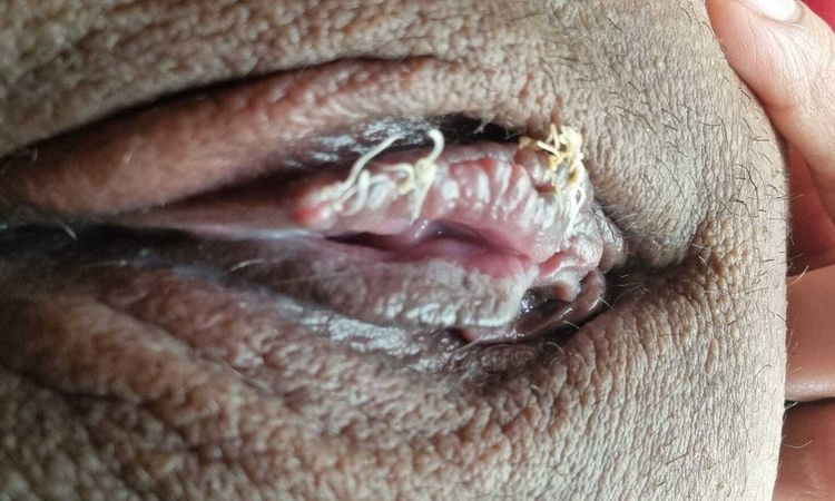 ¿Mala suturación labioplastia? - 80322