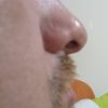 Cirugía después de 2 rinoplastías