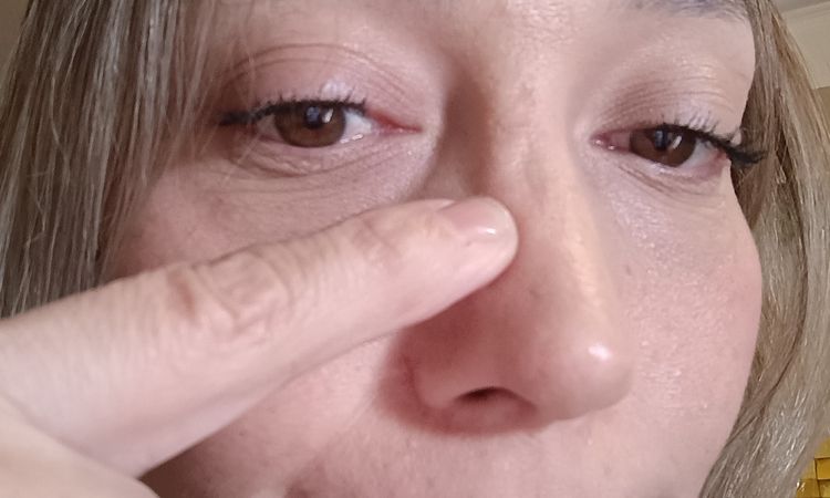 Retoque de la rinoplastia - 81985