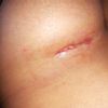 Esfacelo en una cicatriz de mi aumento mamario