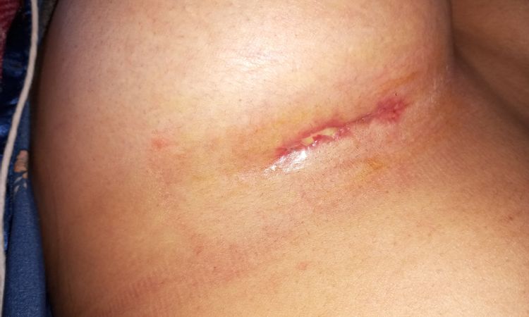 Esfacelo en una cicatriz de mi aumento mamario - 82059