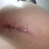 Esfacelo en una cicatriz de mi aumento mamario