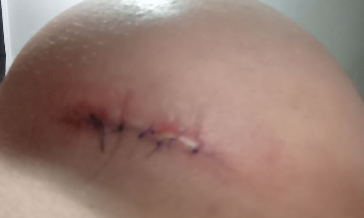 Esfacelo en una cicatriz de mi aumento mamario - 82060