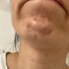 ¿Cómo funciona el bótox?