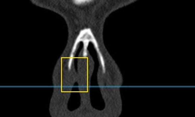 Problema post segunda cirugia de rinoseptoplastia - 82301
