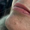 Quiero retirar un lunar del rostro