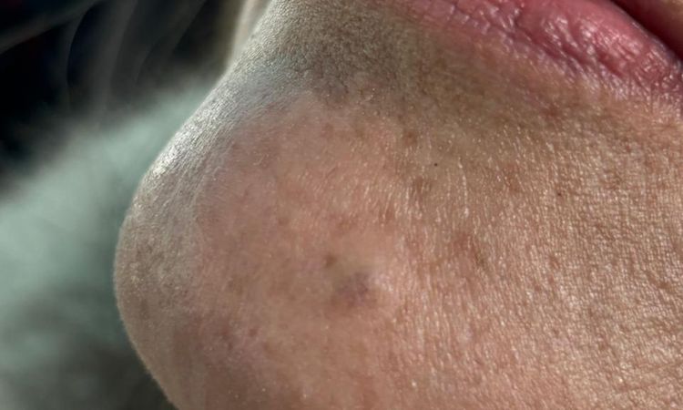 Quiero retirar un lunar del rostro - 82359